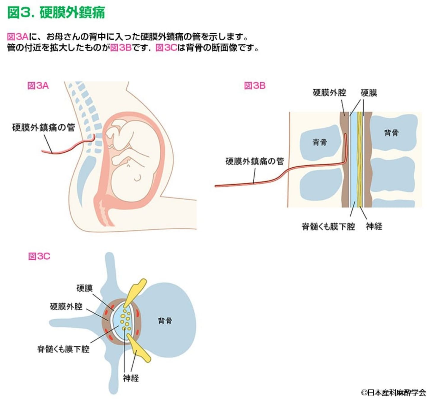 硬膜外鎮痛