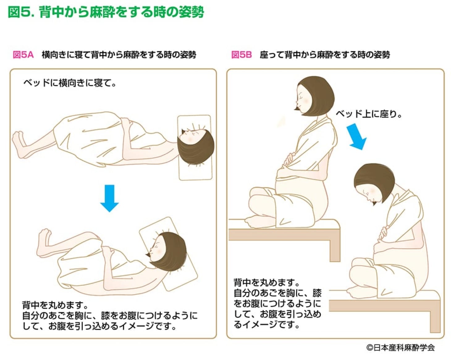 背中から麻酔をするときの姿勢