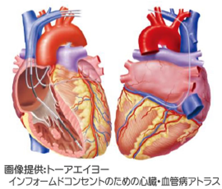 不整脈に対するデバイス治療