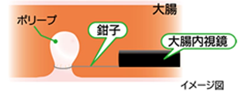 下部消化管内視鏡(大腸内視鏡)