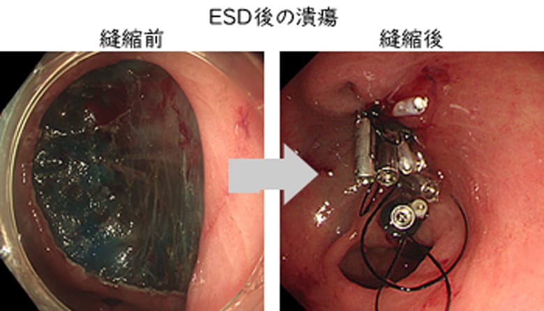 当院におけるESDの取り組み