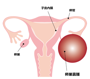 卵巣嚢腫の図