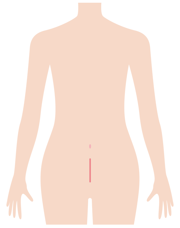開腹手術の手術部分