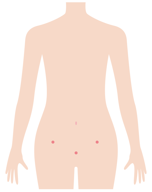 腹腔鏡手術の手術部分