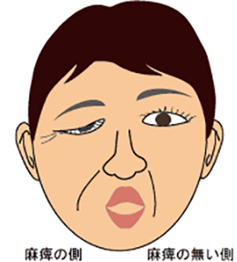 顔面神経麻痺