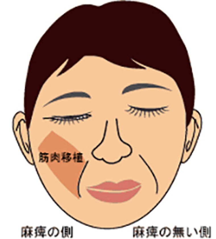 顔面神経麻痺