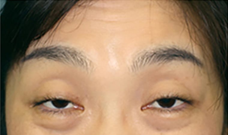 典型的な腱膜性下垂症