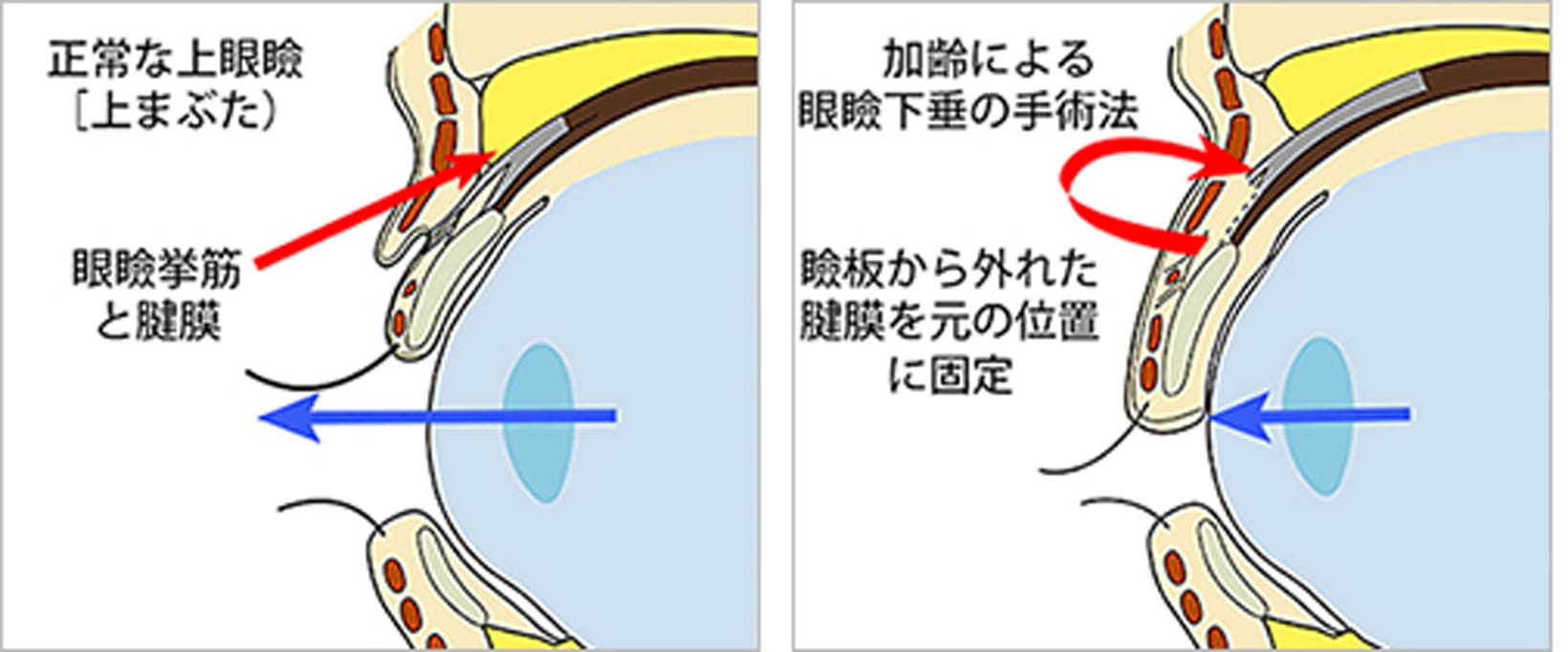 手術法
