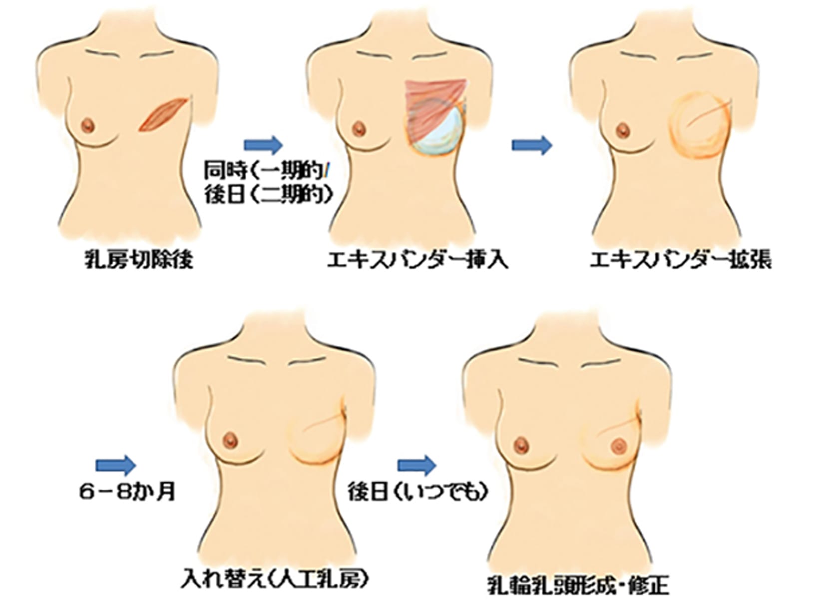 乳房再建の流れ