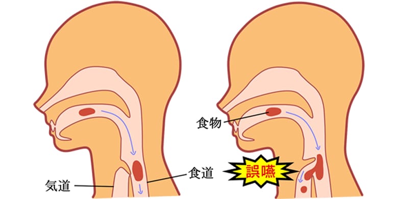 誤嚥性肺炎