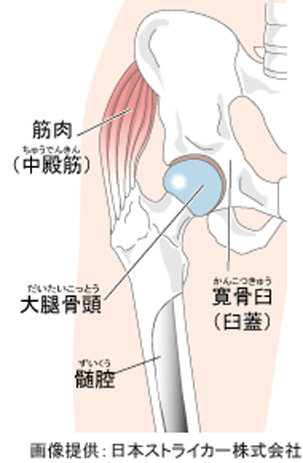 変形性股関節症イメージ