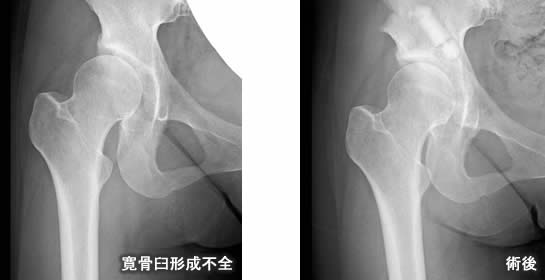 寛骨臼形成不全の手術前後