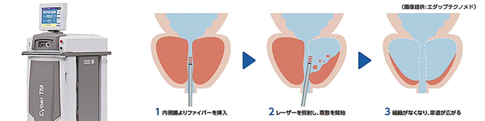 レーザーによる尿路結石治療