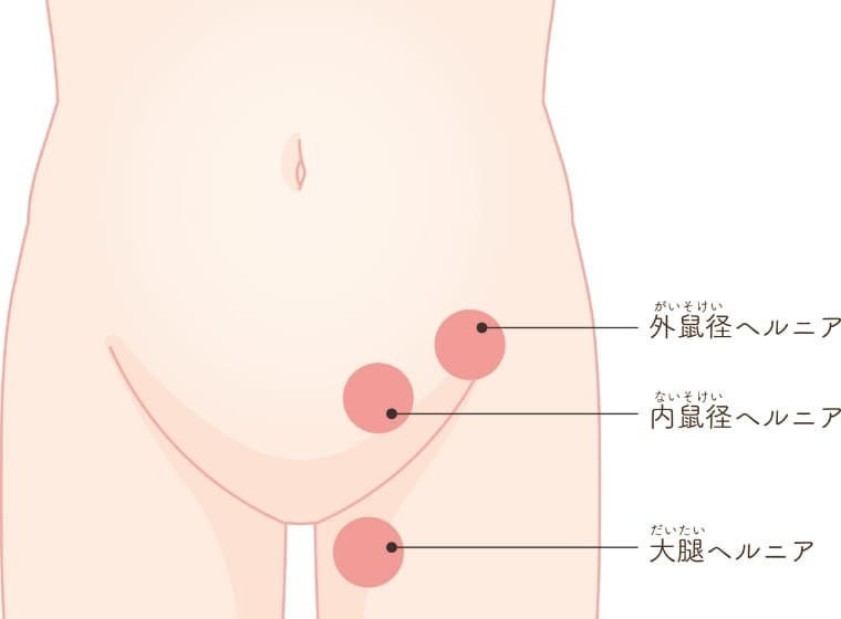 そけいヘルニア外来